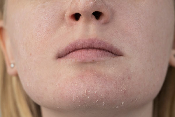 image of excessively dry skin due to poor air quality from hvac system