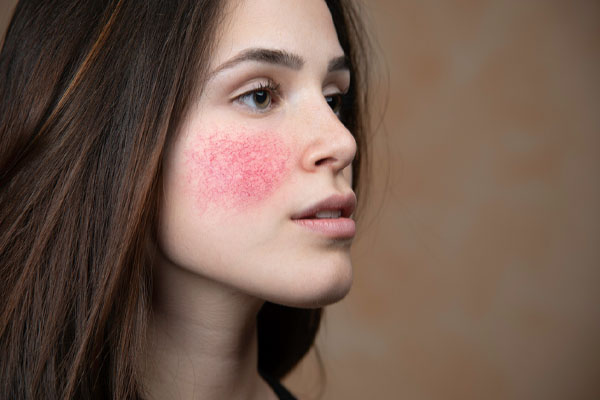 image of rosacea caused by poor indoor air quality